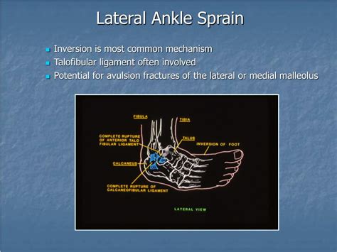 Talofibular Ligament Injury Clinical Presentation 